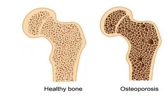 预防骨质疏松,这个检查越早做越好!