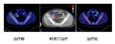卓越的肿瘤杀手--射波刀