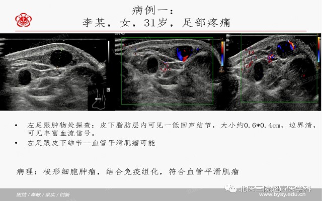 五大痛性浅表肿瘤（一）