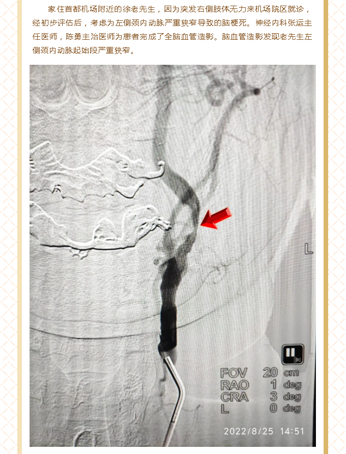 北医三院机场院区导管室顺利开展首例脑血管造影及颈动脉狭窄支架植入术