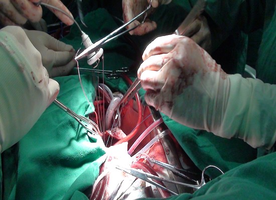 我院心脏外科手术量创新高