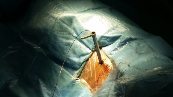 椎间孔镜(脊柱内镜)手术问与答