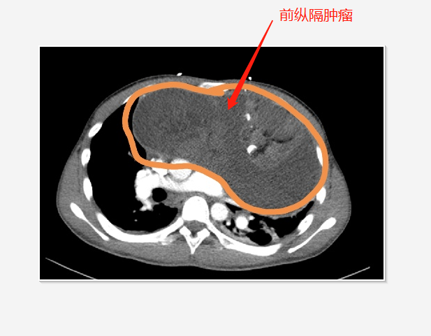 胸外科为一名患者成功切除前纵隔巨大肿瘤