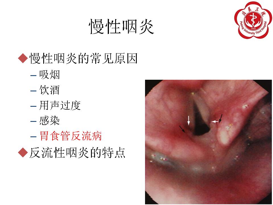 胃食管反流病的食管外表现与治疗