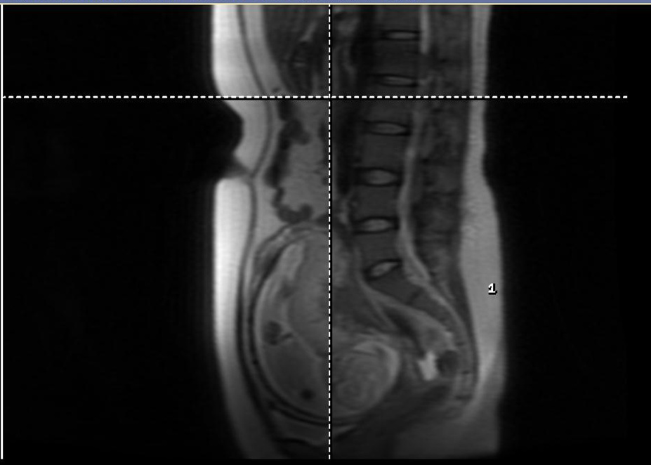 泌尿外科成功为妊娠18周患者完成腹腔镜保留肾单位的肾脏巨大肿物切除术