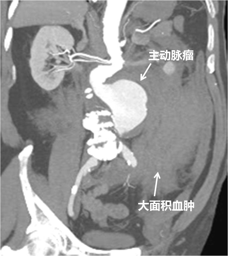 介入血管外科成功抢救一例破裂性腹主动脉瘤合并休克患者