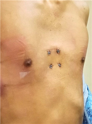 胸外科采用新技术成功治疗一名重度漏斗胸患者