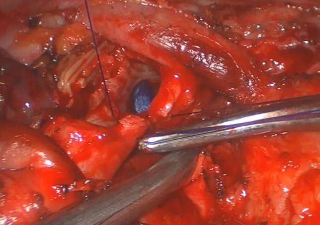 腔镜袖状切肺难 多科协作救重患 胸外麻醉血管介入手术室SICU联手成功救治术后重度急性肺栓塞