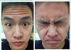 如何有效预防面瘫后遗症