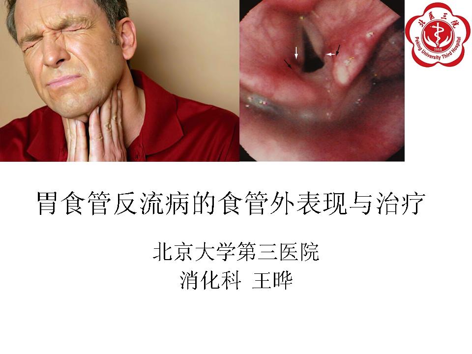胃食管反流病的食管外表现与治疗