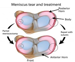 应对膝关节的“炎”重警告,康复医学专家给您支招!