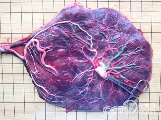 双胎输血综合征