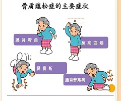 预防骨质疏松,这个检查越早做越好!