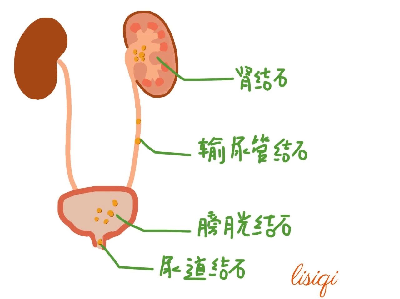 尿石症 | 不同结石成分，各有自己的防治方法