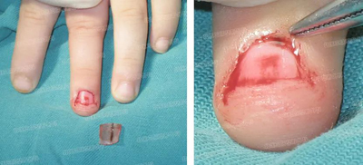 指甲上长黑线需要治疗吗?