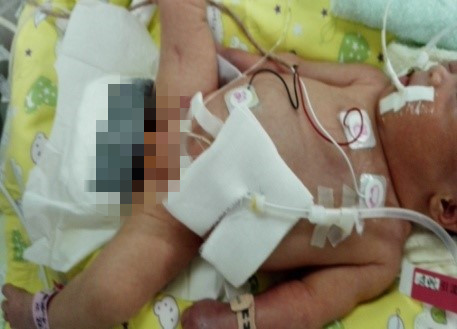 北京大学第三医院新生儿重症监护病房（NICU）