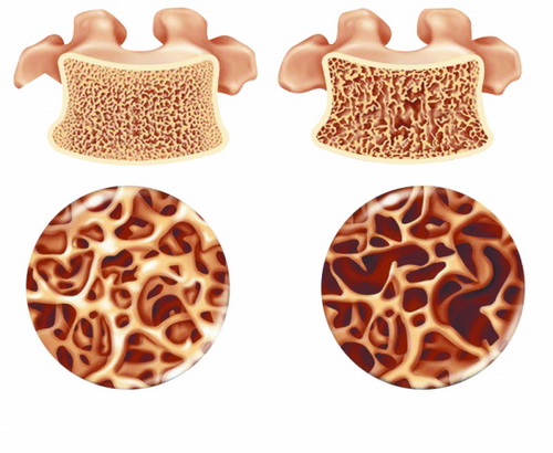 骨质疏松.jpg