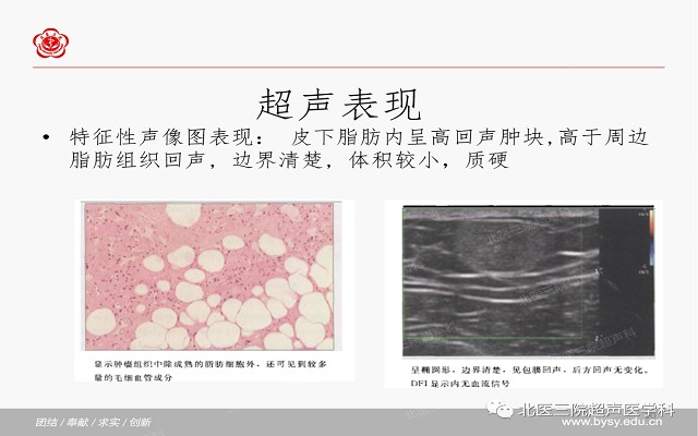 五大痛性浅表肿瘤（一）