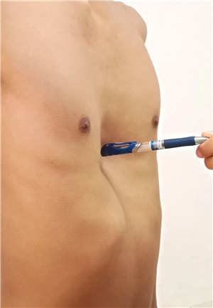 胸外科采用新技术成功治疗一名重度漏斗胸患者