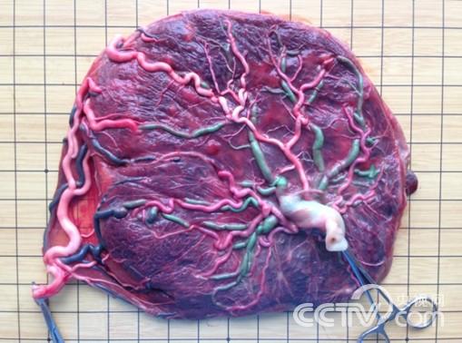 选择性宫内生长受限胎盘图例