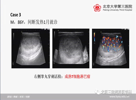 病例回顾与学习之睾丸畸胎瘤