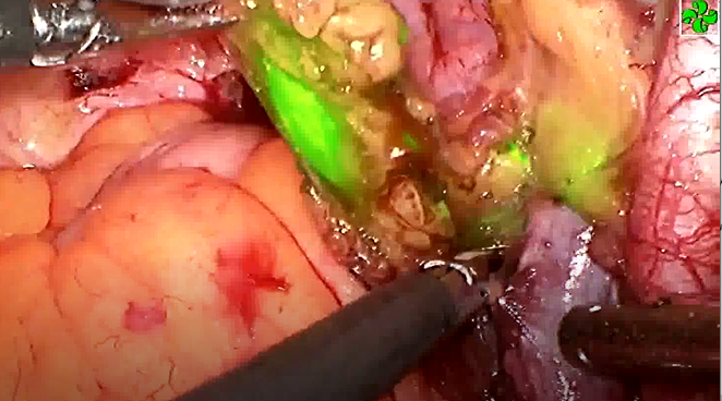 磁共振融合荧光导航腹腔镜前列腺癌盆腔淋巴结清扫技术