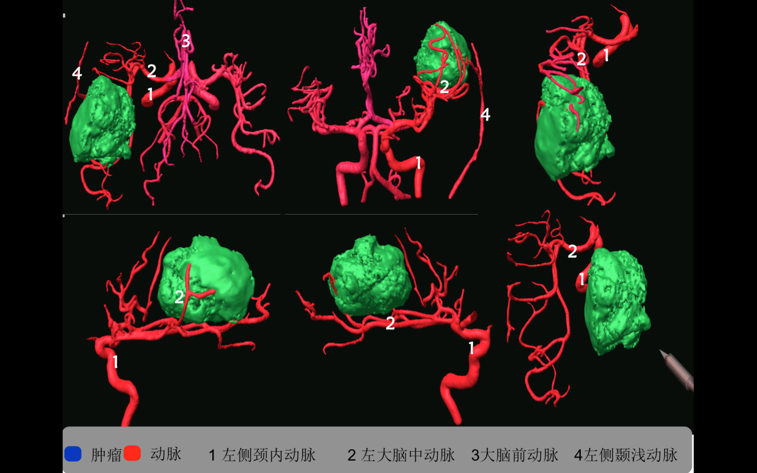 多模态影像融合及术中导航技术精准切除功能区胶质瘤