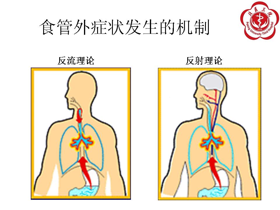 胃食管反流病的食管外表现与治疗