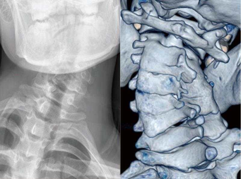 颈椎组典型病例