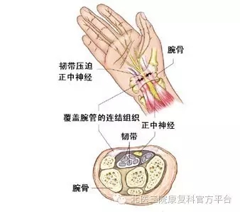 浅谈“腕管综合征”康复方法