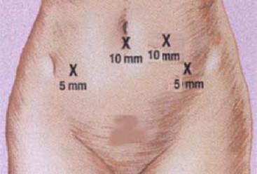腹腔镜手术腹壁切口