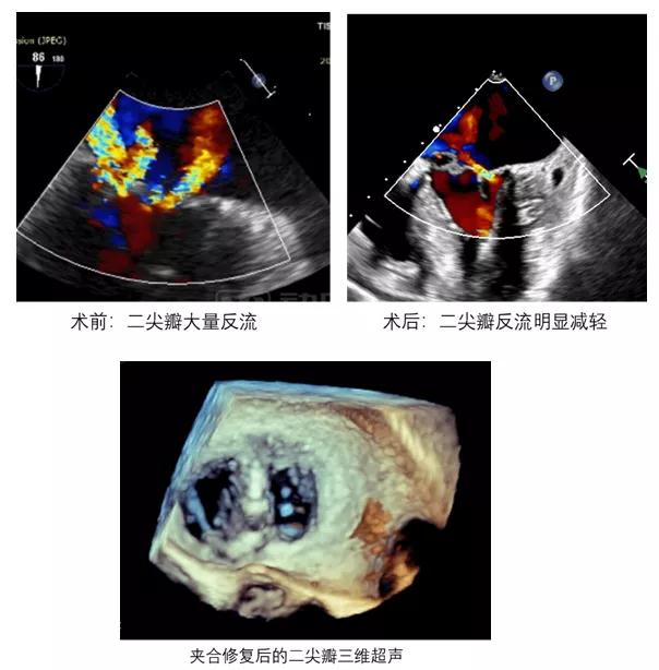 近九旬老人重获“心”生 北医三院完成首例经导管二尖瓣修复术
