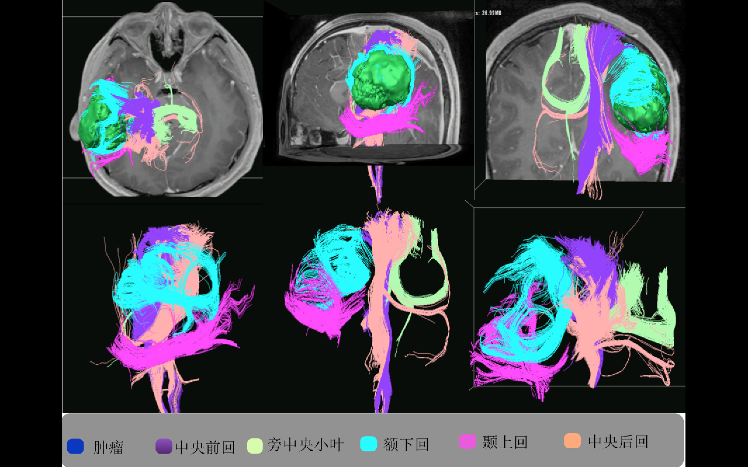 多模态影像融合及术中导航技术精准切除功能区胶质瘤