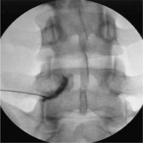 神经根/背根神经节阻滞联合脉冲射频镇痛术
