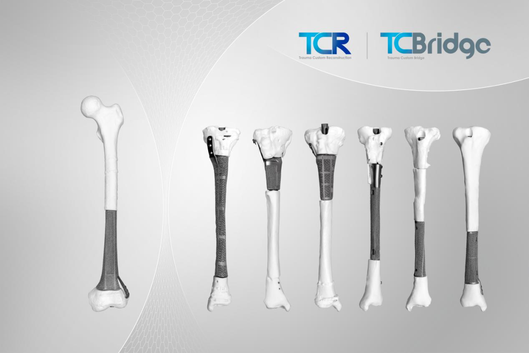 国内首款，获批上市！3D打印助力长段骨缺损修复