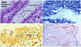 终结幽门螺杆菌的一切疑问,专家帮您健康无“幽”