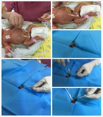 北京大学第三医院新生儿重症监护病房（NICU）