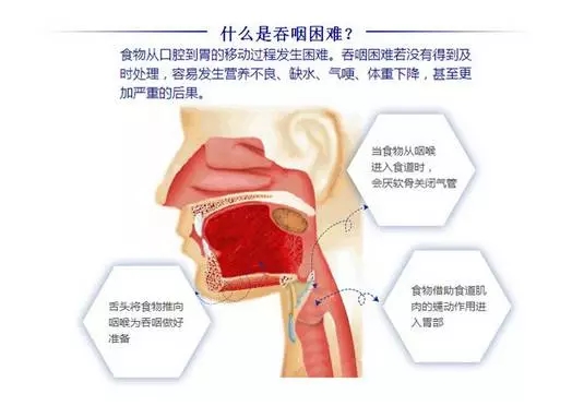 关于吞咽困难，我们可以做点什么？