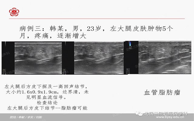 五大痛性浅表肿瘤（一）