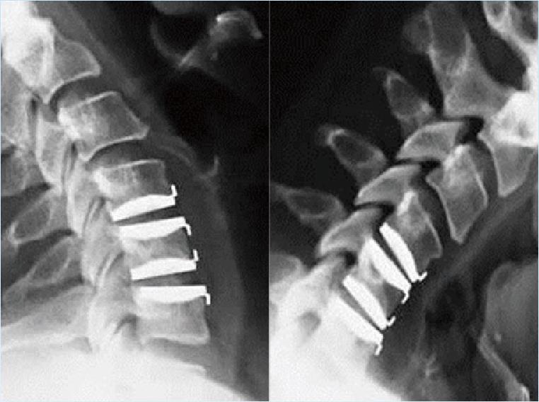 颈椎组典型病例