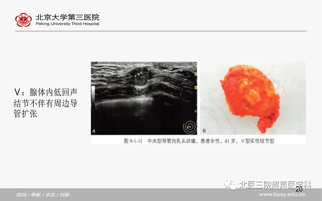 病例回顾与学习之乳腺导管内乳头状瘤