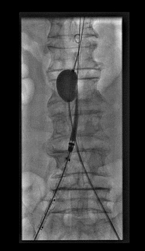 介入血管外科成功抢救一例破裂性腹主动脉瘤合并休克患者