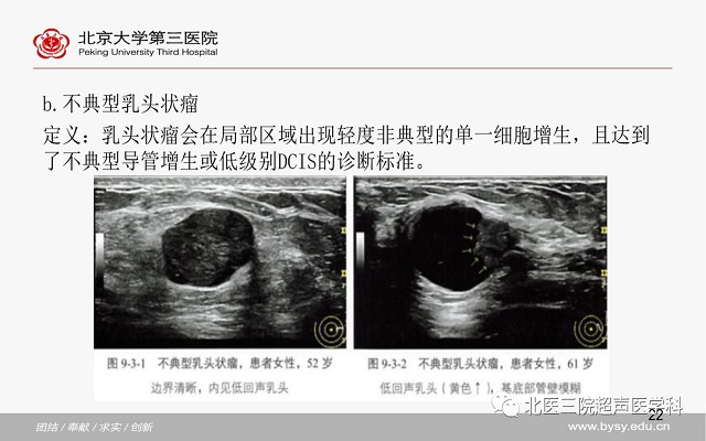 病例回顾与学习之乳腺导管内乳头状瘤
