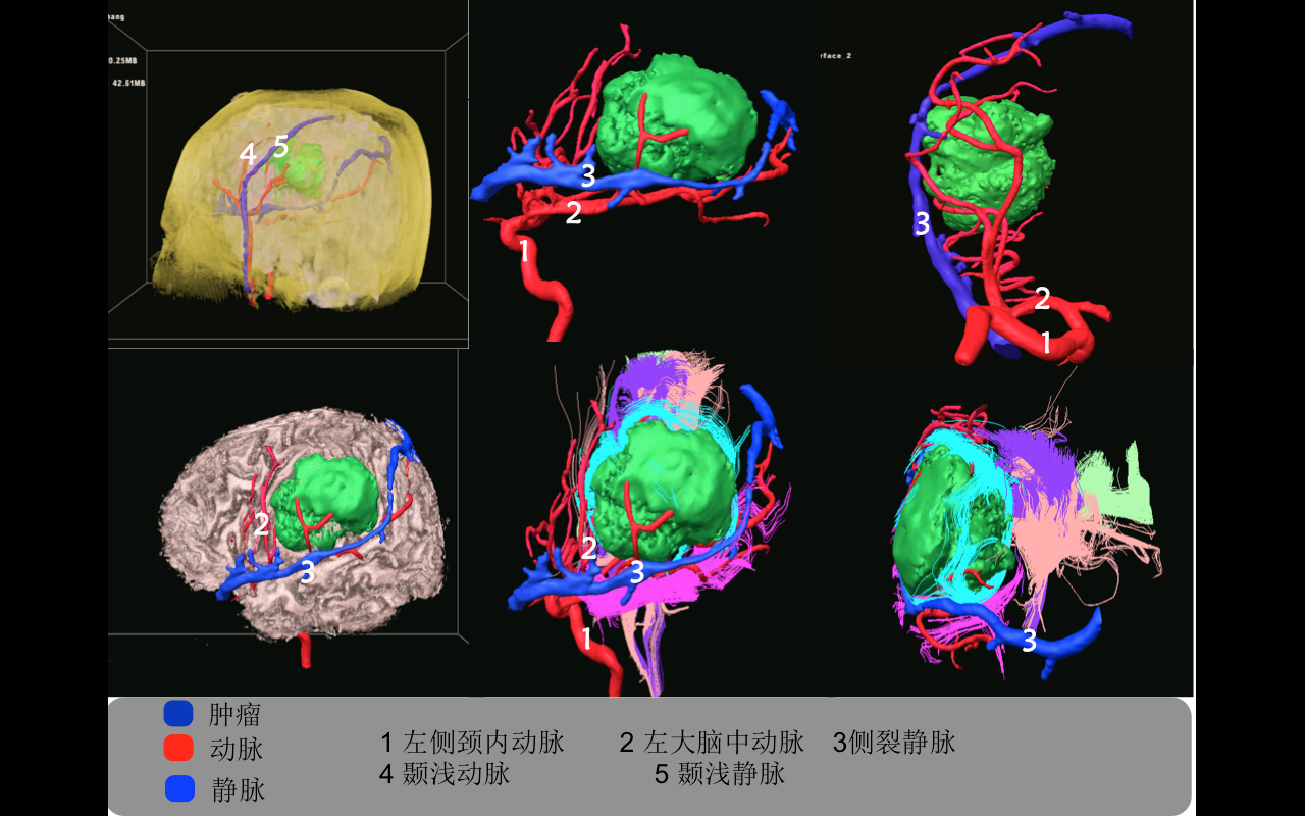 多模态影像融合及术中导航技术精准切除功能区胶质瘤