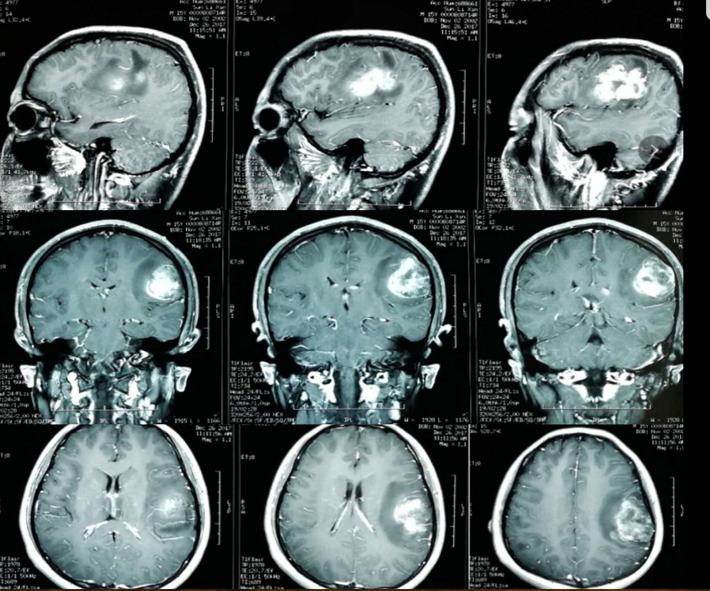 多模态影像融合及术中导航技术精准切除功能区胶质瘤