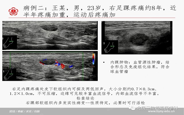 五大痛性浅表肿瘤（一）
