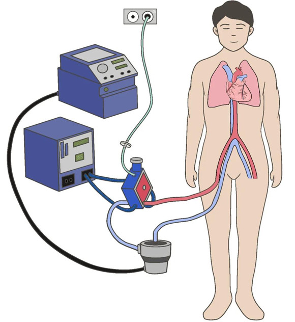 体外心肺复苏术——心脏骤停患者的新希望【2020医疗技术创新二等奖】 