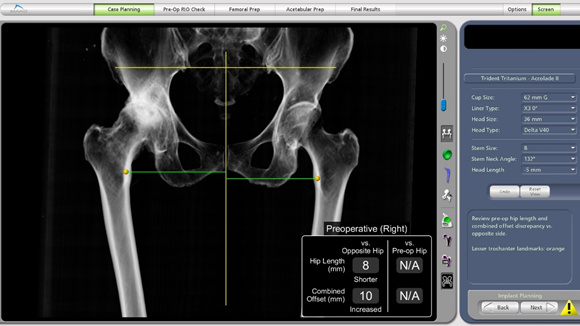 骨科完成我院首例骨科机器人辅助髋关节置换术