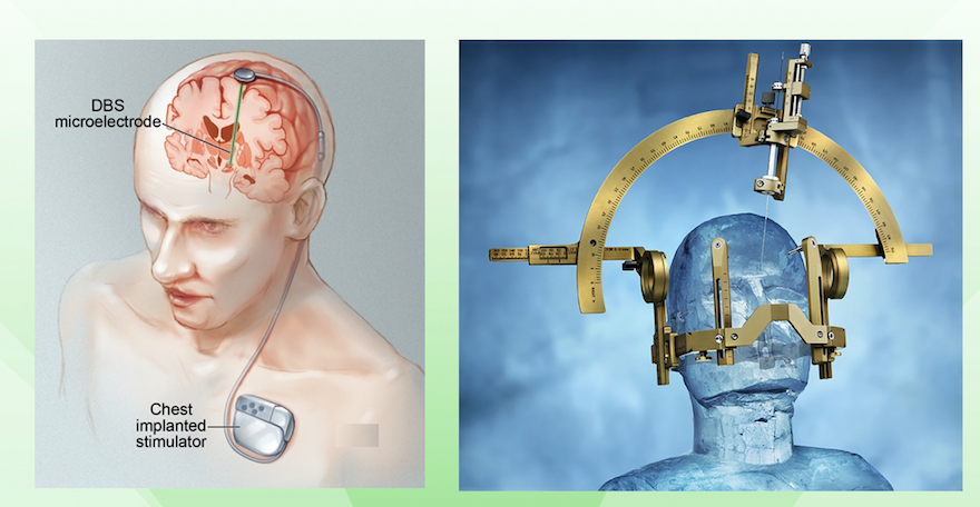 脑功能疾病的DBS（脑起搏器植入术）治疗