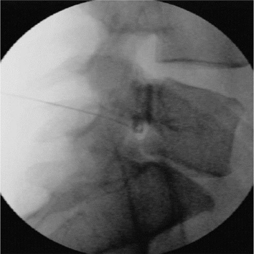 神经根/背根神经节阻滞联合脉冲射频镇痛术